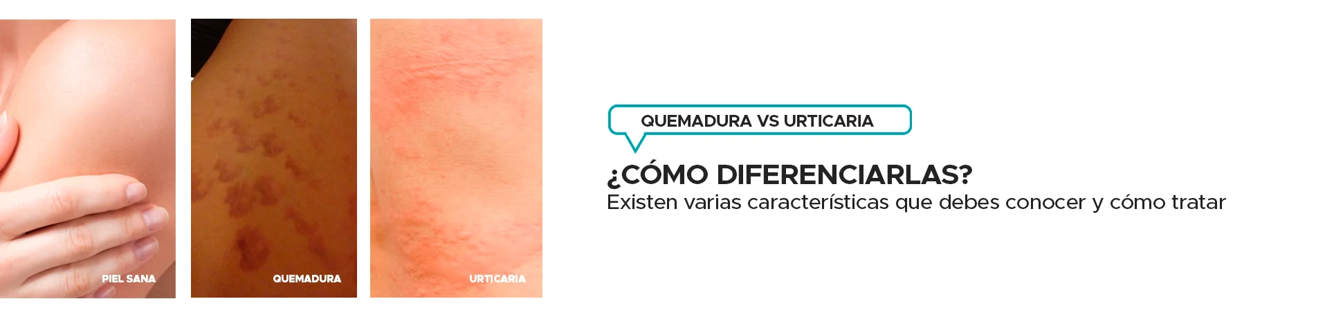 Como diferenciar quemaduras y urticarias por depilacion laser